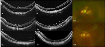 Vitrectomy With Silicone Oil Tamponade and Without Internal Limiting Membrane Peeling for the Treatment of Myopic Foveoschisis With High Risk of Macular Hole Development